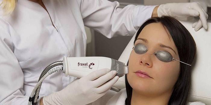 Chica hacer peeling láser superficial