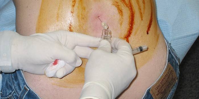 Diagnostická metóda mozgovej encefalitídy - lumbálna punkcia