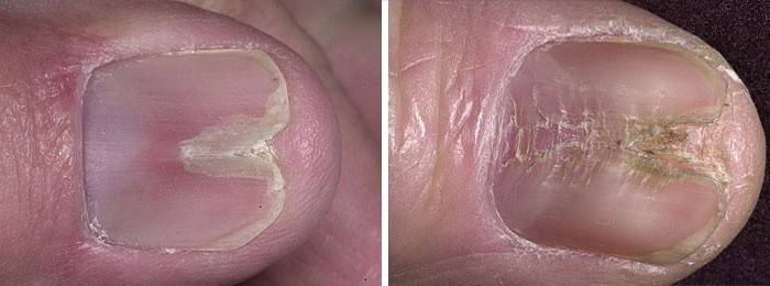 Sinais de uma patologia mediana das unhas em forma de canal