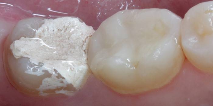 Preenchimento temporário em um dente