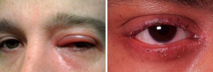Inflamación ocular: causa adelgazamiento de las pestañas