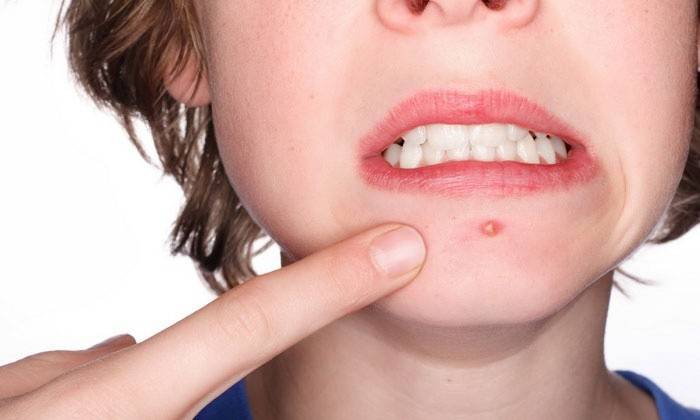 Por que a acne aparece no meu rosto?