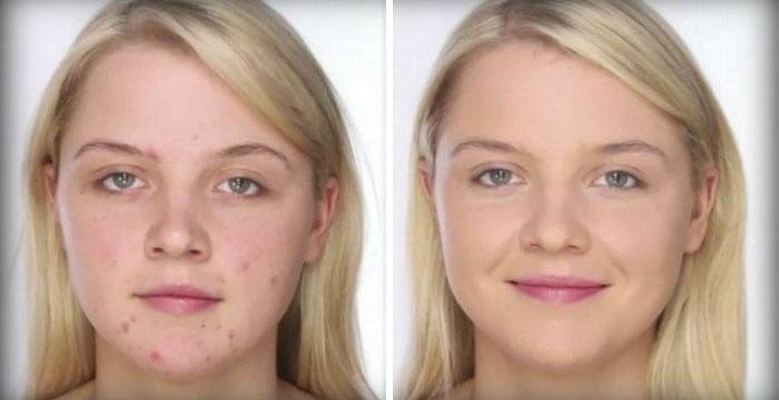 Corretivo ajuda a mascarar a acne