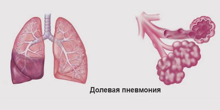 Pneumonia lobar