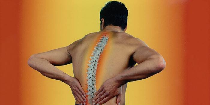 Espondilitis anquilosante en hombres