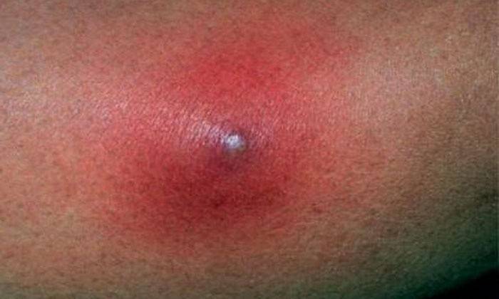 Acne purulenta grande no rosto