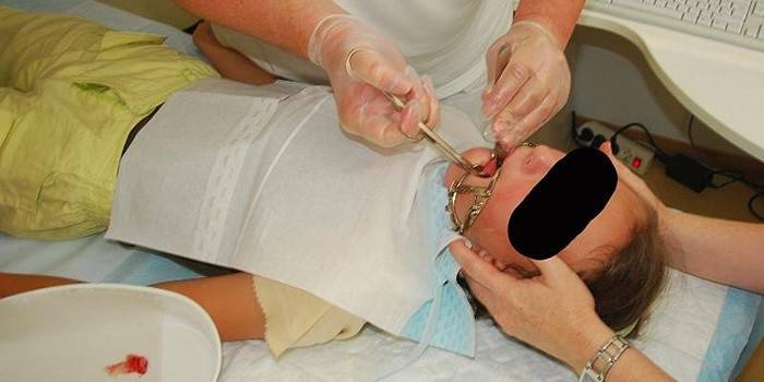 Adenotomia - operação para remover adenóides