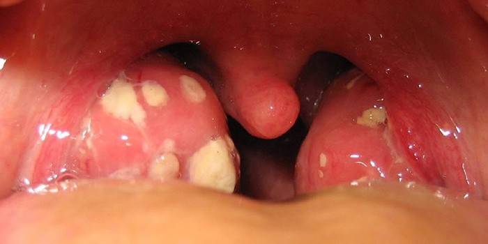 Abscesso paratonsilar