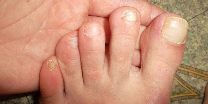 Onicomicosis