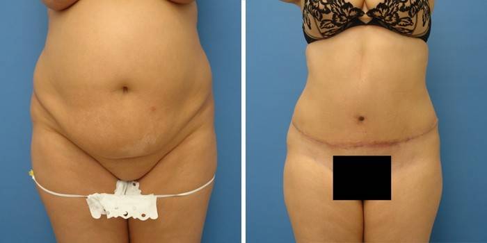 Fotos antes y después de la abdominoplastia del abdomen.