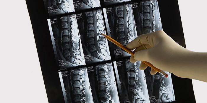 MRI chrbtice na diagnostiku štípaného nervu