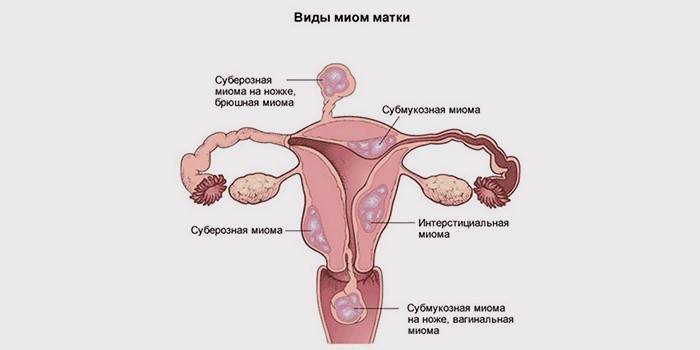 Variedades de miomas uterinos