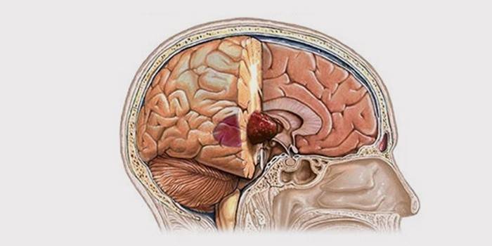 Tumor cerebral