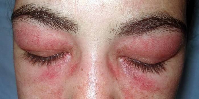 Autoimunitné ochorenie kože - diskoidný lupus erythematodes