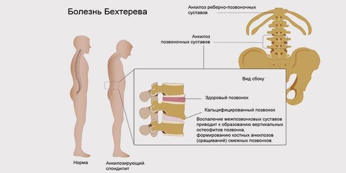 Síntomas de espondilitis anquilosante