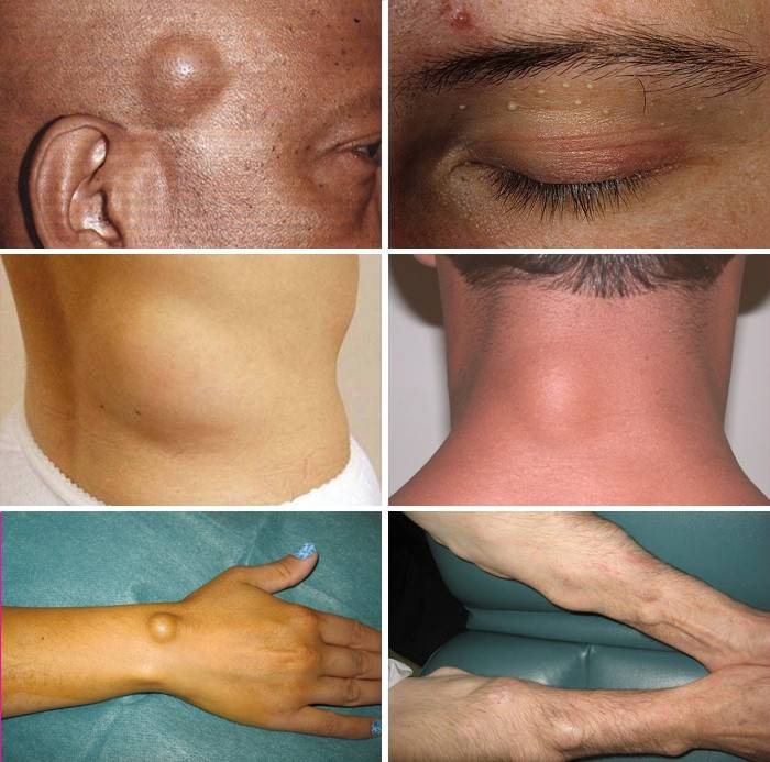 Tipos de Lipomas
