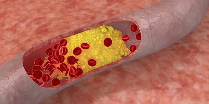 Síntoma de colesterol alto en sangre