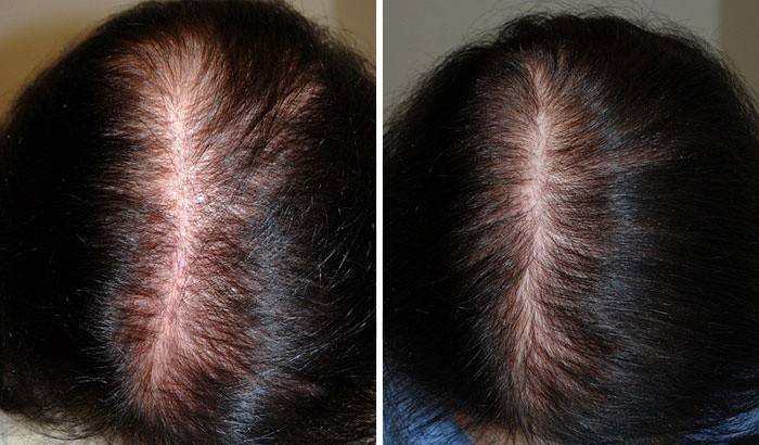 Cabello antes y después de los procedimientos de mesoterapia.