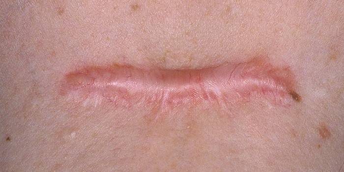 Blizna Keloid