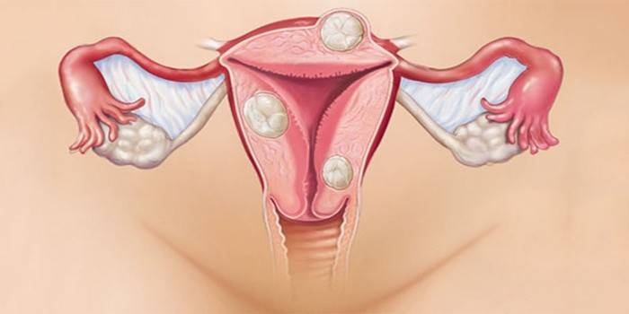 Maternicové myómy s menopauzou