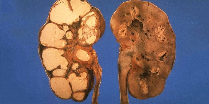 Tuberculose renal