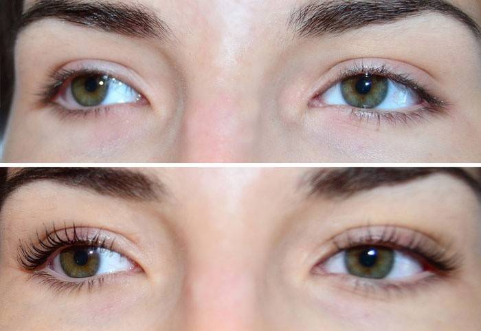 Olhos da menina antes e depois do procedimento
