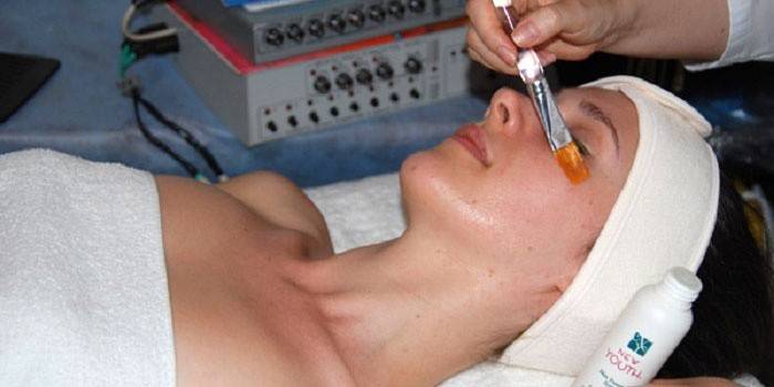 Remoção de pigmentação facial: peeling químico