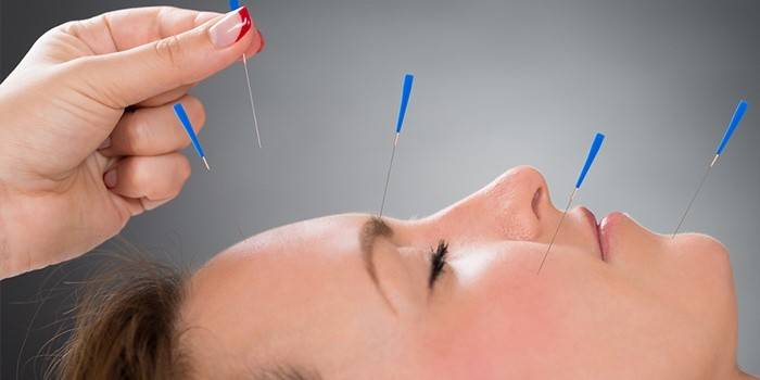 Acupuntura para neurite do nervo facial