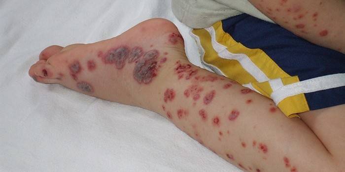 Autoimunitné ochorenie krvi - trombocytopenická purpura