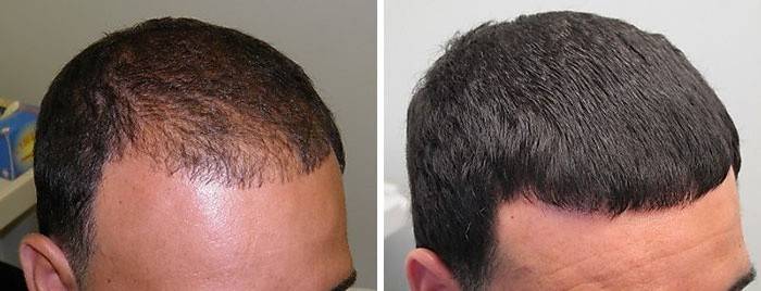 El resultado de la mesoterapia capilar.