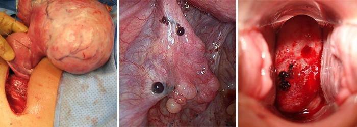 Indicaciones para la extracción del útero.