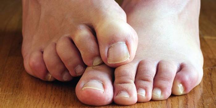 Enfermedades por hongos en las uñas