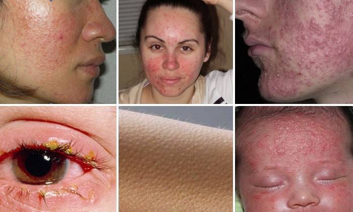 Demodex no rosto