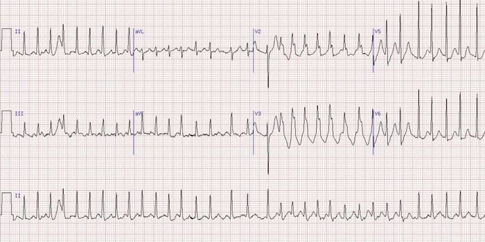Cardiograma de perturbação do ritmo cardíaco