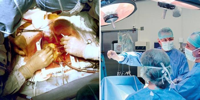 Cirugía de fibromas uterinos