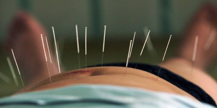 Procedimento de acupuntura