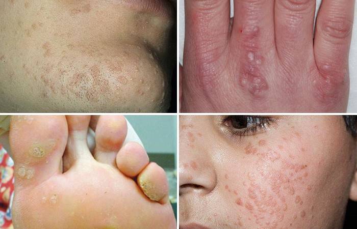 Áreas do corpo Wart