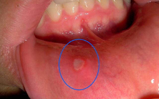 Estomatite catarral em um adulto
