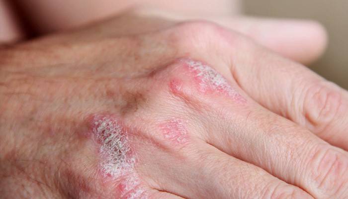 Signo de psoriasis: erupción con pápulas