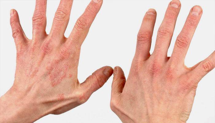 La etapa inicial de la psoriasis.