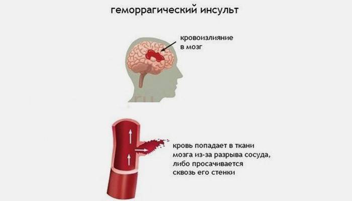 Tipo hemorrágico de acidente vascular cerebral