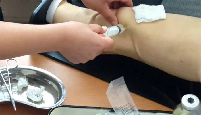 Tratamiento de sinovitis de rodilla