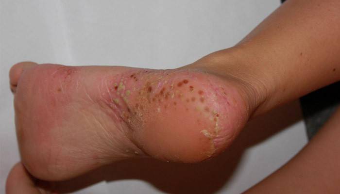 Suelas