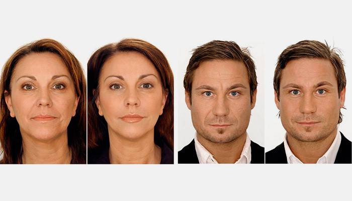 Fotografie pred a po injekcii kyseliny hyalurónovej