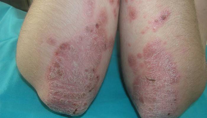 Psoriasis pustulosa de la mano