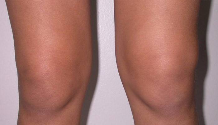 Sinovitis de la rodilla