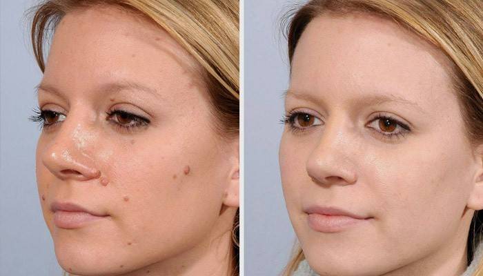 Garota antes e depois do procedimento