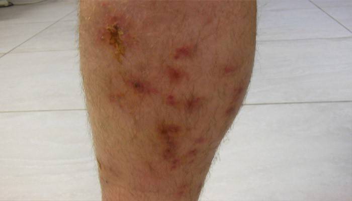 Erysipelas stopy