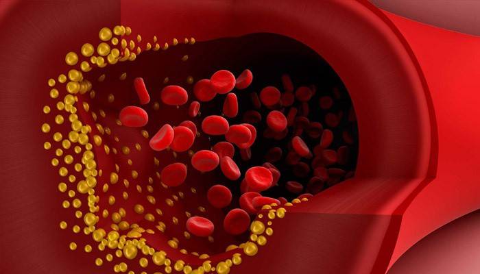 Placas de colesterol en la sangre