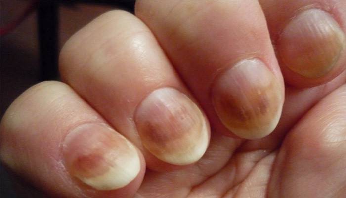Levadura de uñas
